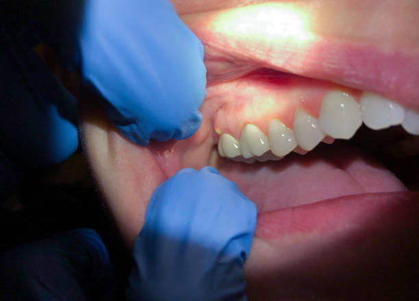 Best Emergency Treatment for Dental Infections or Abscesses in Lake Barrington, IL