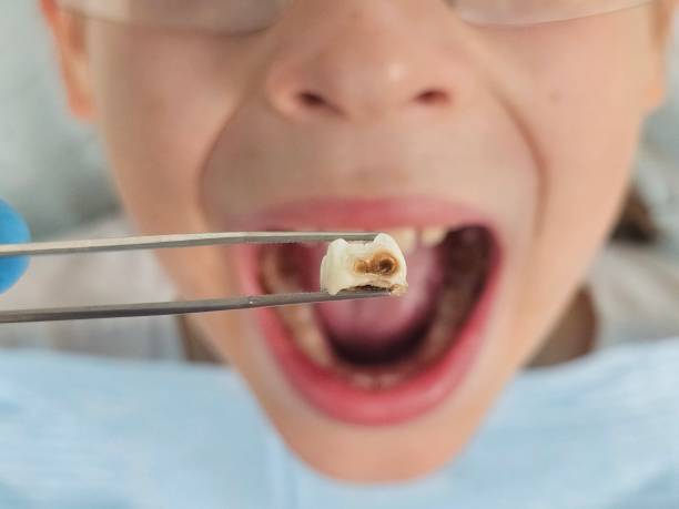 Best Emergency Dental Care for Broken or Chipped Teeth in Lake Barrington, IL